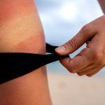 tratament-naturist-arsuri-piele