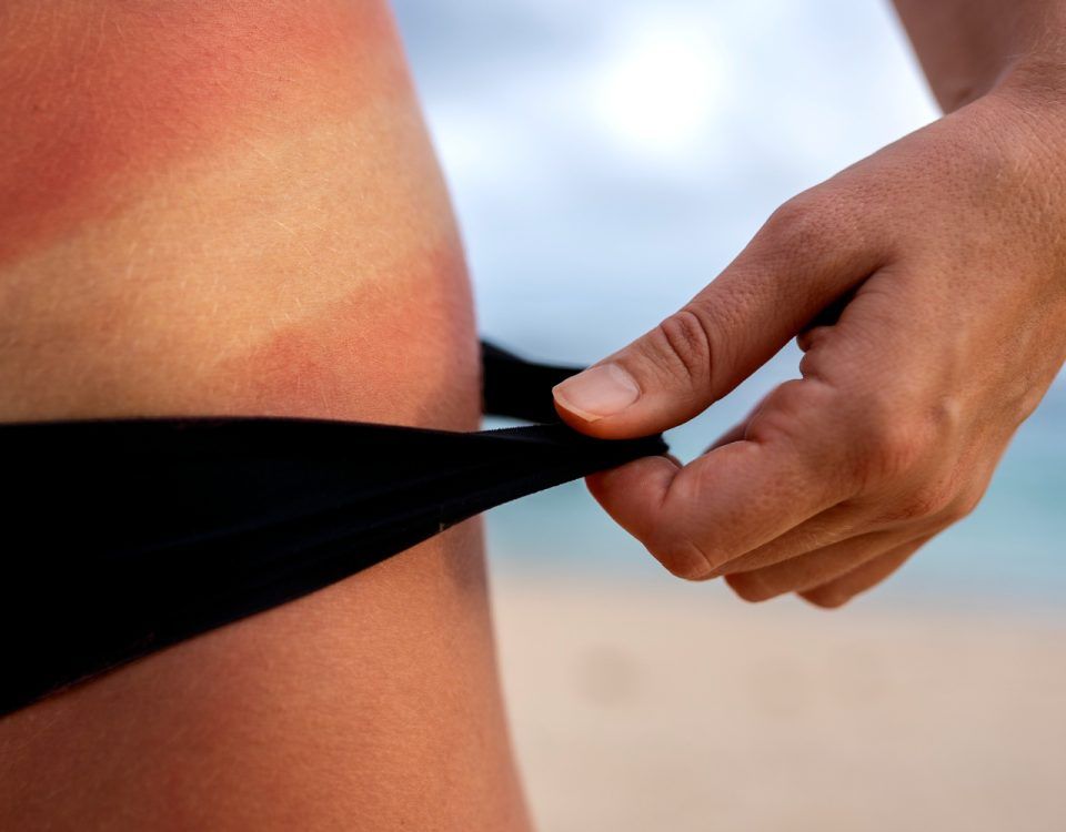 tratament-naturist-arsuri-piele