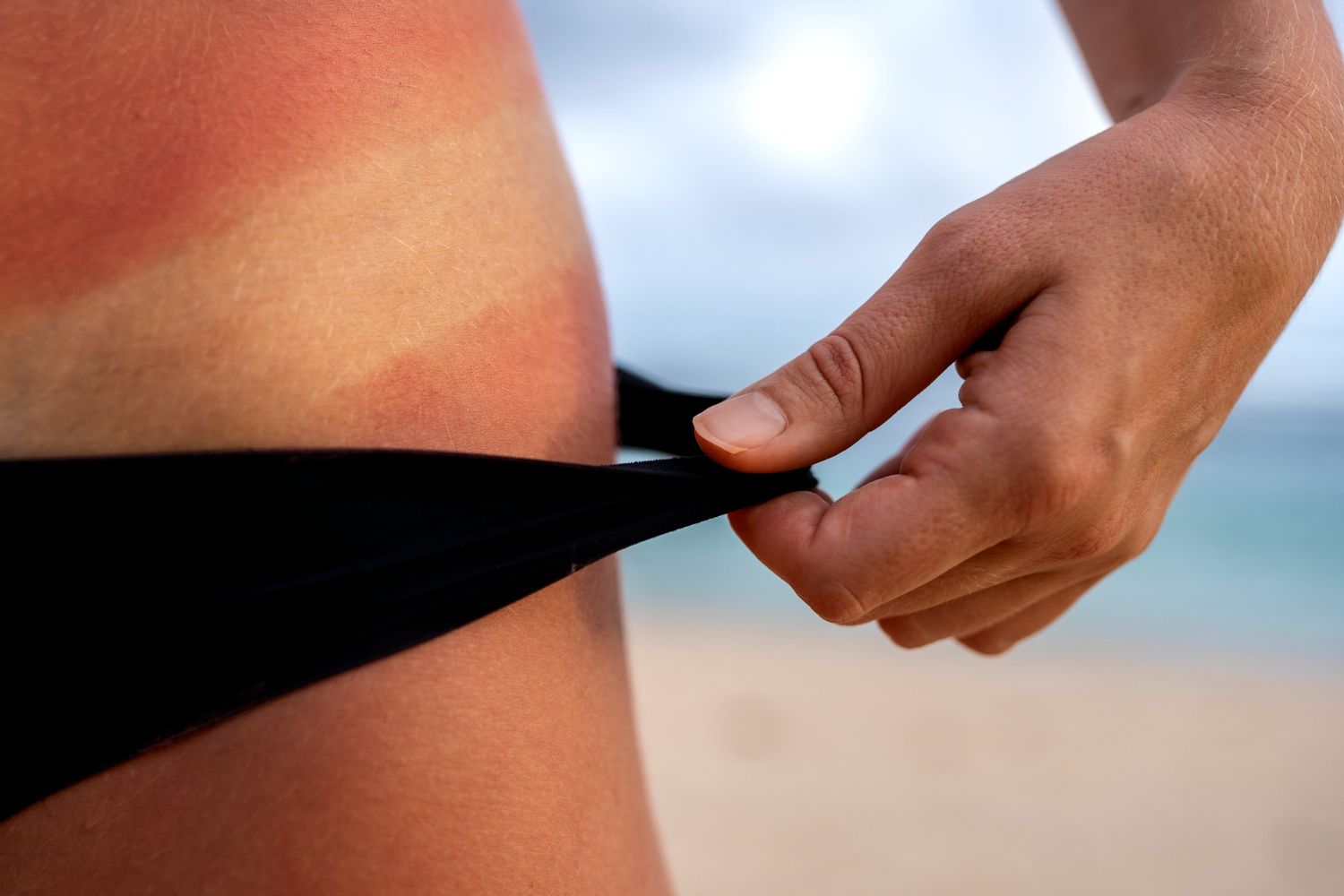tratament-naturist-arsuri-piele